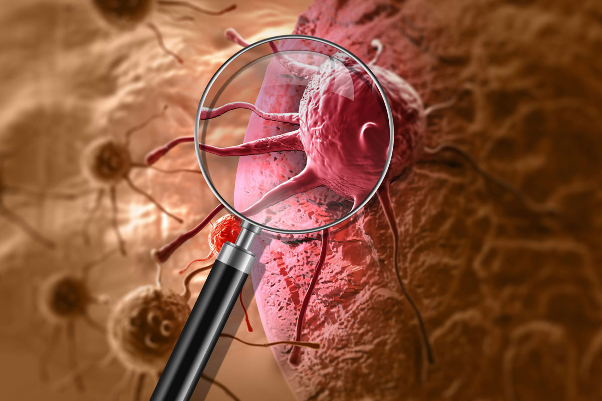 Immune System Intends To Fight Pancreatic Cancer Cells