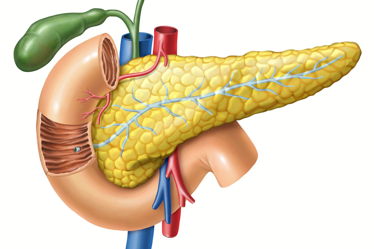 Onset Diabetes With Weight Loss Show 7-Times Risk of Pancreatic Cancer
