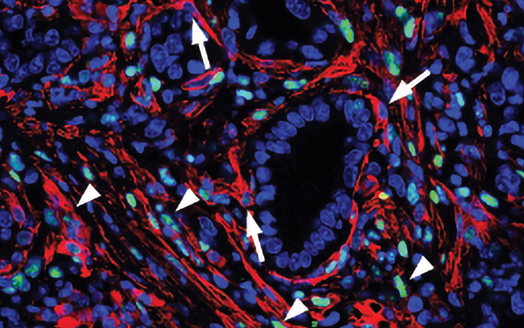 PCDA Stroma Shell Protects Its Tumors