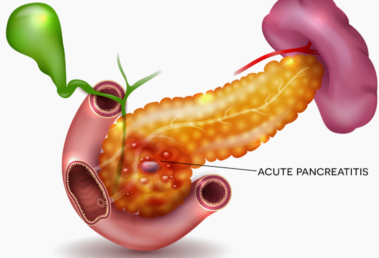 Illustration showing a typical inflammation in the pancreas refereed to as acute pancreatitis